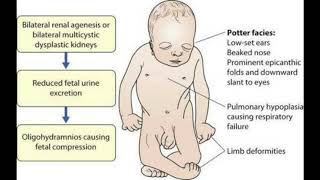 Oligohydramnios and polyhydroaminos 2 [upl. by Loni]