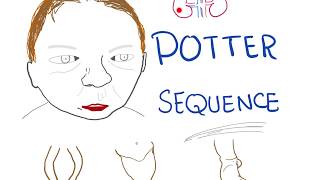 Potter sequence  Oligohydramnios Lowset Ears Flat Face ParrotPeak Nose Lung Hypoplasia [upl. by Annie320]