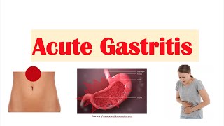 What is Gastritis  The GutDr Explains 3D Gut Animation [upl. by Serilda]