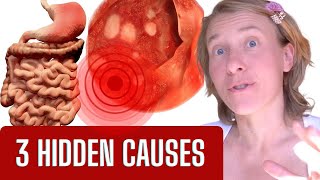 The Hidden Truth What REALLY Causes Gastritis SURPRISE [upl. by Girhiny]