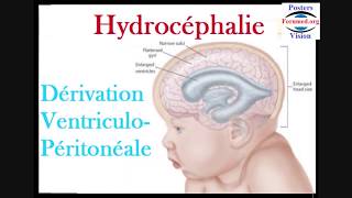 Hydrocéphalie et dérivation ventriculopéritonéale du liquide cérébrospinal [upl. by Marciano]