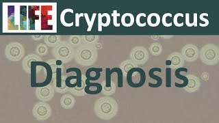 Diagnosing cryptococcal meningitis [upl. by Zednanreh]