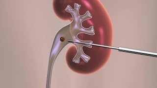 Percutaneous Nephrolithotomy [upl. by Del]