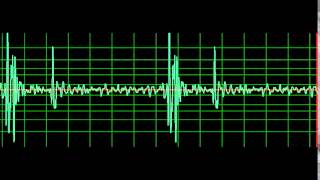 Normal Heart Sound slow [upl. by Iret505]