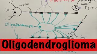 Oligodendroglioma [upl. by Arimas]