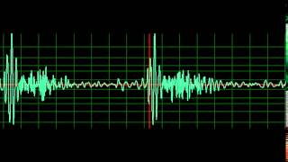 Mitral Regurgitation normal speed [upl. by Ativak615]