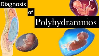 Diagnosis of Polyhydramnios [upl. by Ahsieyt221]