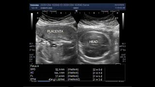 Ultrasound Video showing Oligohydromnios loss of fetal movements with Pregnancy of about 22 weeks [upl. by Niwdla203]