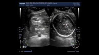 Ultrasound Video showing Oligohydromnios  almost Anhydramnios  with Pregnancy of 30 weeks [upl. by Rosalind128]