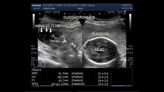 Oligohydramnios with loss of fetal movements and Pregnancy of about 23 weeks [upl. by Blanc]