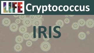 Cryptococcal IRIS [upl. by Koeninger588]